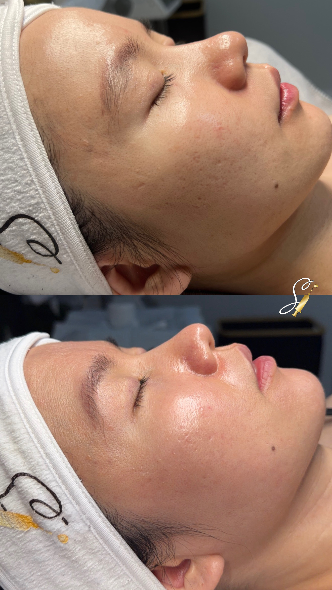 Clinical Microneedling Treatment