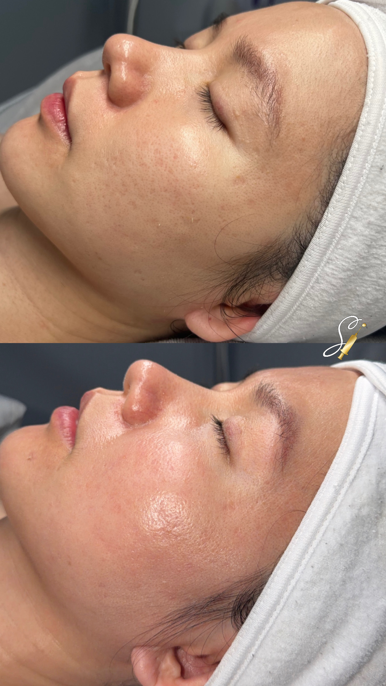 Client Microneedling Result 6