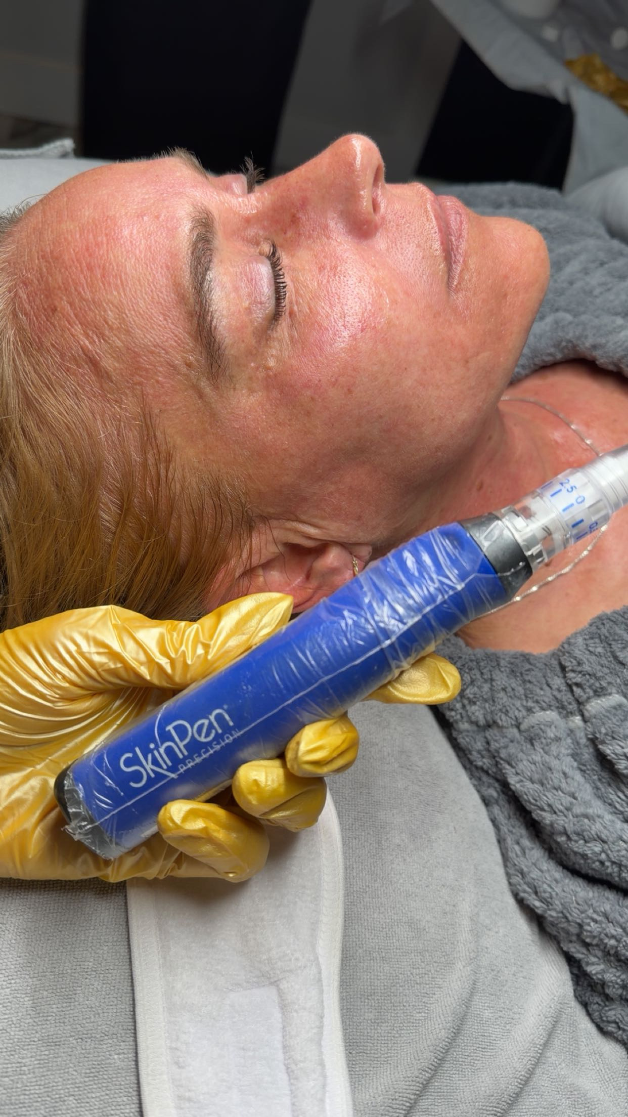 Client Microneedling Result 1