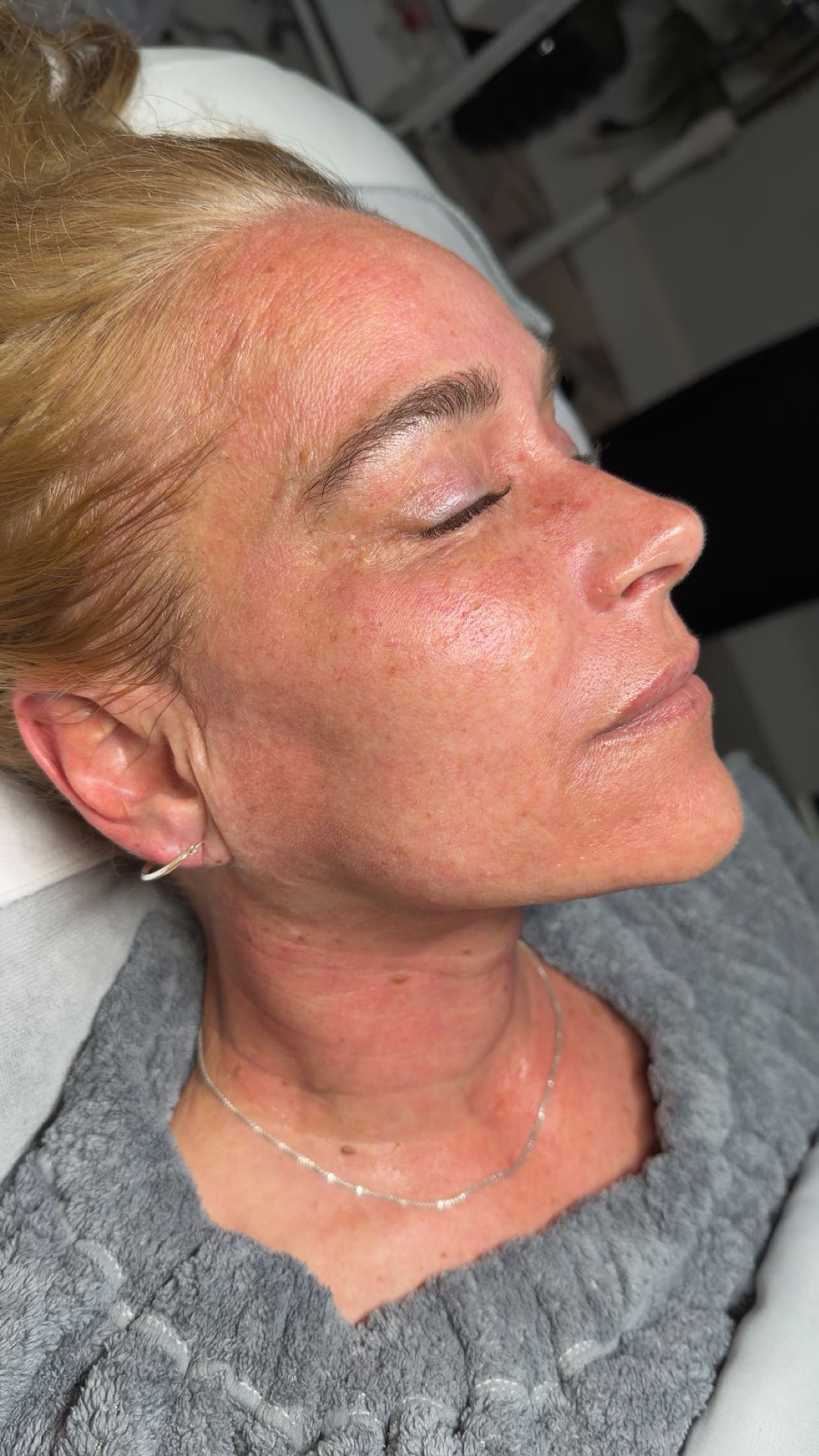 Client Microneedling Result 2