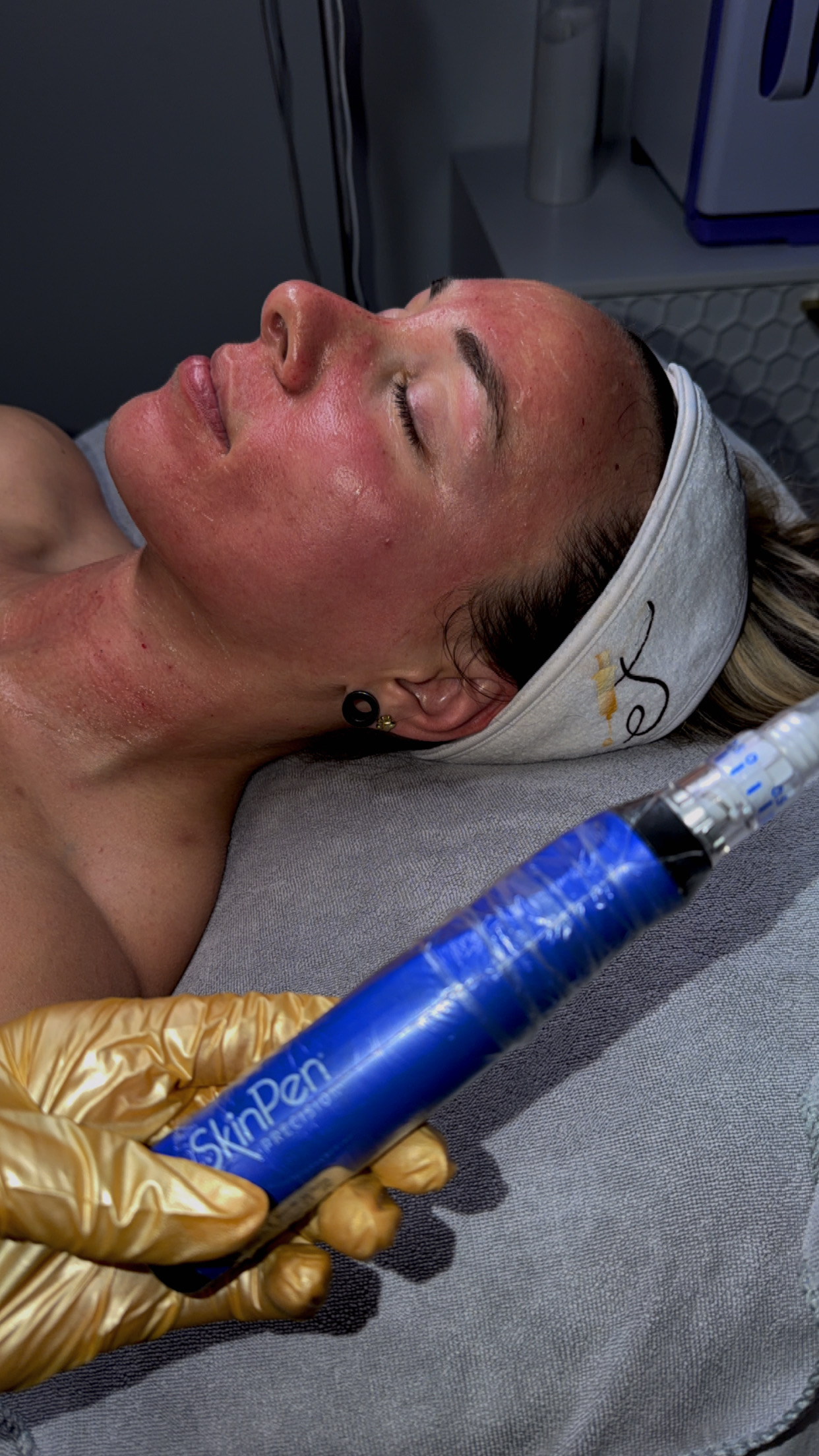 Client Microneedling Result 3