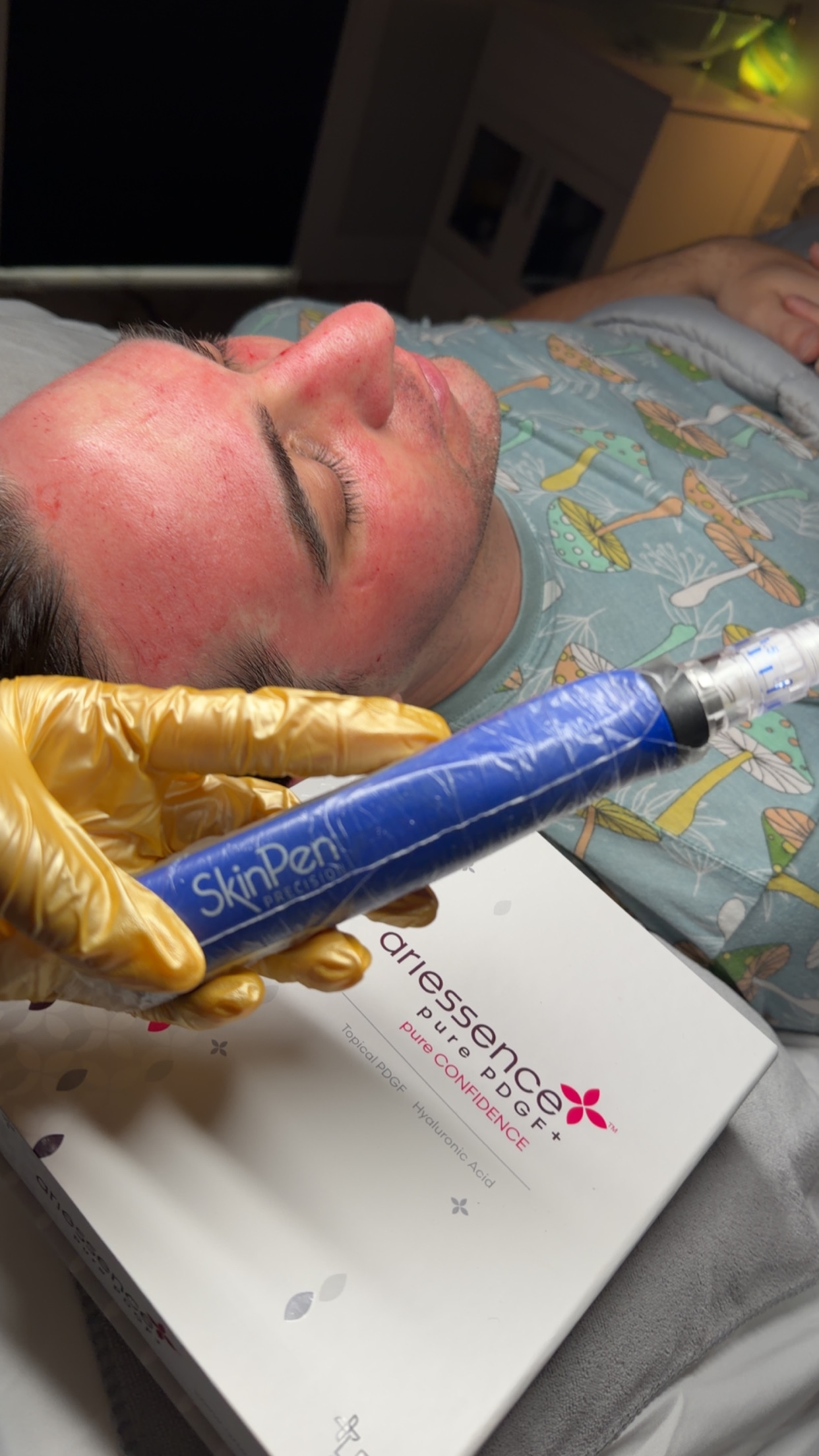 Client Microneedling Result 5